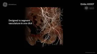 Embo ASSIST with Virtual Injection - Simulate your embolization procedure