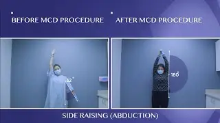 See How Our Patient was Cured From Frozen Shoulder