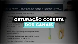 Como Fazer Obturação dos Canais Radiculares: Guia Completo de Endodontia