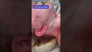 Ever Wonder what Happens During a Facelift? Watch This and See! 
