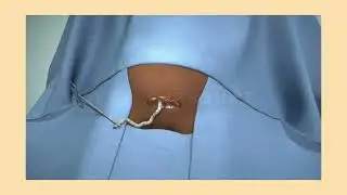 c section oprat