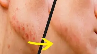Photoshop ile Sivilce Temizleme - Photoshop Eğitimi