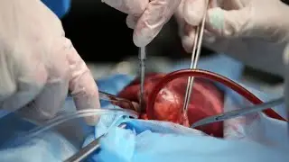 Orthotopic Heart Transplant Using Bicaval Technique Part 2: Implantation of Donor Heart