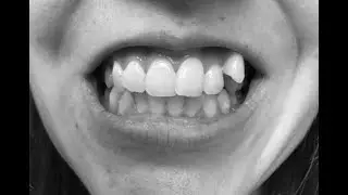 Braces Time Lapse // 15 months in 30 seconds