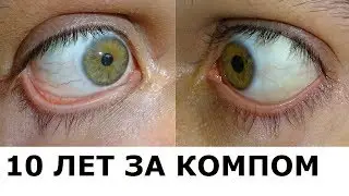 Dry Eye Syndrome - #1 My Terrible Story