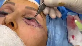 Complicanze da filler acido ialuronico alle palpebrale