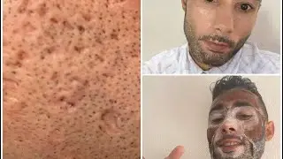 Peeling de fenol profundo