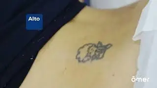 O Autêntico Laser Picossegundos  | Ômer Premium da Medical San