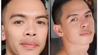 RHINOPLASTY| SINO DOCTOR & MAGKANO INABOT