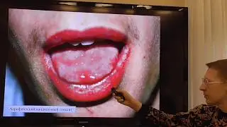 Кандидоз