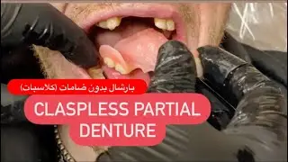 MAKING PARTIAL DENTURE WITHOUT CLASPS (FLIPPER) ALL STEPS FROM CAST TO INSERTION 