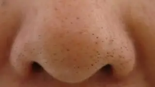 How to remove Blackheads