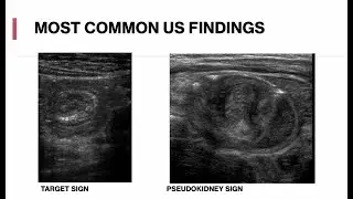 Pediatric Abdominal Ultrasound - Appendicitis, Intussusception, Mesenteric Adenitis