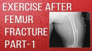 Exercise After Femur Fracture Part-1| Thigh Bone Fracture Rehabilitation