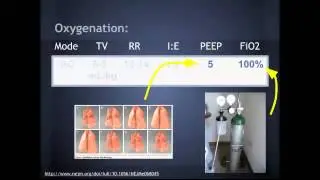 Lung Protective Vent Settings:  