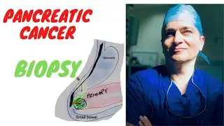 Pancreatic Cancer - Biopsy (when, why, how)