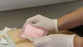 IODOSORB 0.9% Cadexomer Iodine Application - Pressure Ulcer