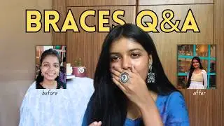 My Braces Experience & Honest Q&A | Part 1 