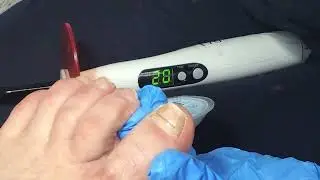 Установка титановой нити на ноготь