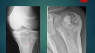 Chondroblastoma case presentation (short)