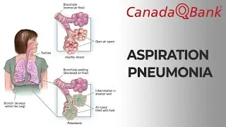 Aspiration Pneumonia Explained | Causes, Diagnosis & Treatment | CanadaQBank