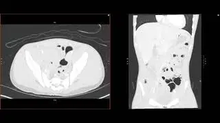Abdominal Imaging Call Prep Cases: A​p​p​e​n​d​i​c​i​t​i​s​​/A​b​s​c​e​s​s​ ​(​C​T​) Case 1
