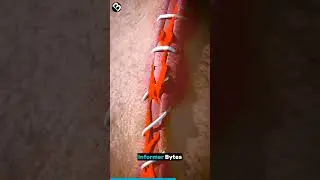 How Stitches Heal Wounds