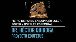 Filtro de pared en Doppler  Color, Power y Doppler Espectral