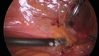 Laparoscopic ureterolysis: Techniques and approaches for ureter identification and dissection