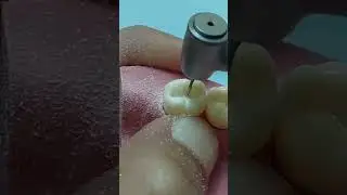 ازاله تسوس كلاس ١ سنه لور ٧ #dr_ghazal #dentist #trending #comment