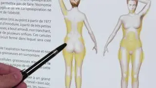 Tout ce qu’il faut savoir sur la liposuccion - Dr. Vincent Hunsinger