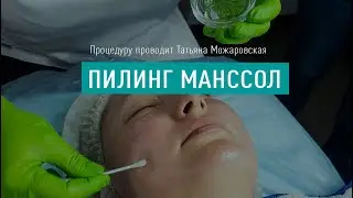 Гайд по процедуре с пилингом мансол (Manssol)