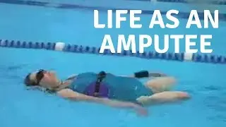 Christine Amosa: Life as an Amputee
