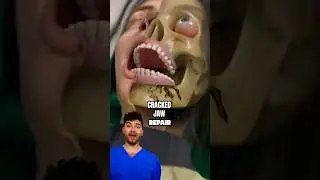 Dentist Explains: Cracked Jaw Repair !?
