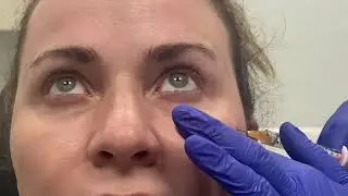 Tear Trough Filler @ Revive Medical Spa