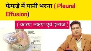 What is Pleural effusion? its Cause Symptoms and Treatment  Explained in Hindi (फेफड़े में पानी)
