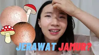 Jerawat Jamur / Fungal Acne? | Beruntusan gatal ga sembuh-sembuh, wajib nonton!