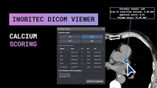Calcium scoring in Inobitec DICOM Viewer Pro