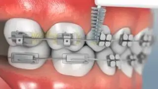 Interproximal Brushing