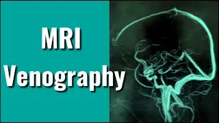 MRI Venography ( Phase - Contrast / 3D )