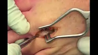Morton's Neuroma