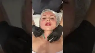 Биоревитализация БИОАКТИВ