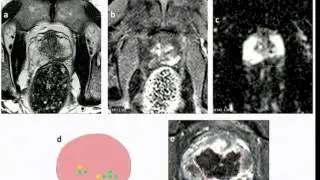 Focal Therapy for Prostate Cancer   Hashim Ahmed