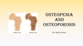 Osteopenia and osteoporosis - definition, types, investigation, DEXA scan, treatment, complications