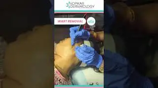 VanishingAct: Unveiling the Magic of Wart Removal! ✨👋 | Expert Technique for Smooth, Bump-Free Skin!