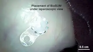 Bioresorbable shape-adaptive structures for ultrasonic monitoring of deep-tissue homeostasis