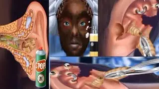 ASMR worm cleaning in the ear and legs/asmr animation video /Earwax remove