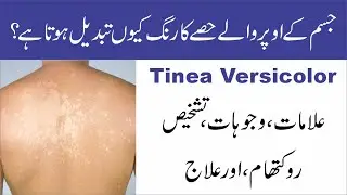 Tinea Versicolor | Symptoms, Causes, Prevention, and Treatment | Urdu/Hindi