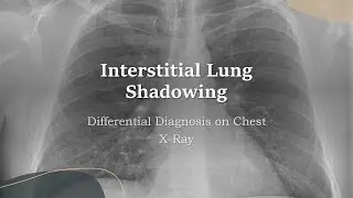 Causes of Interstitial Shadow on Chest X-ray | Differential Diagnosis & Mnemonic to Remember Causes