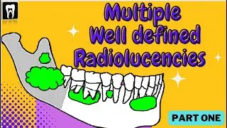 Multiple Separate  Radiolucency With Well Defined Borders | Oral Radiology | Oral Pathology | OKC